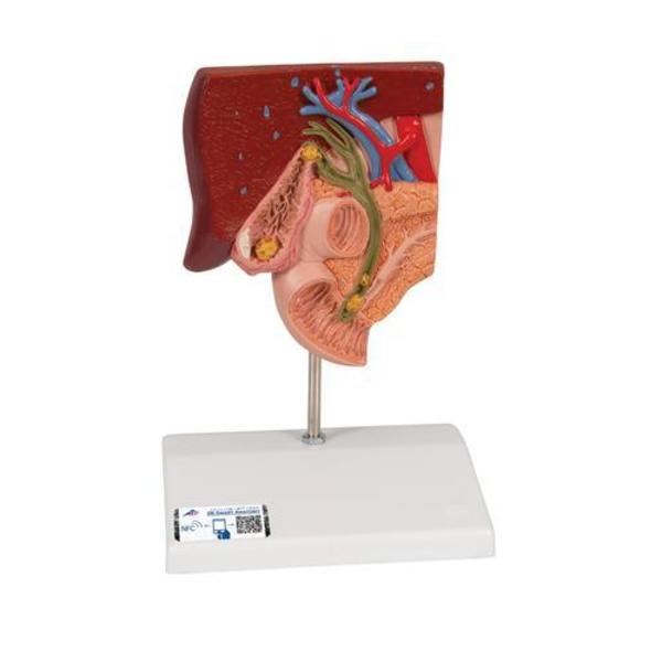 3B Scientific Gallstone Model - w/ 3B Smart Anatomy 1000314